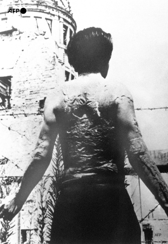 A picture released on August 23, 1951 shows a man's scars from burns in the Hiroshima bombing - AFP